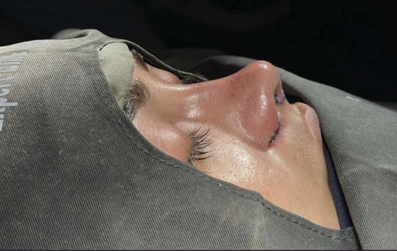 After rhinoplasty - straight bridge