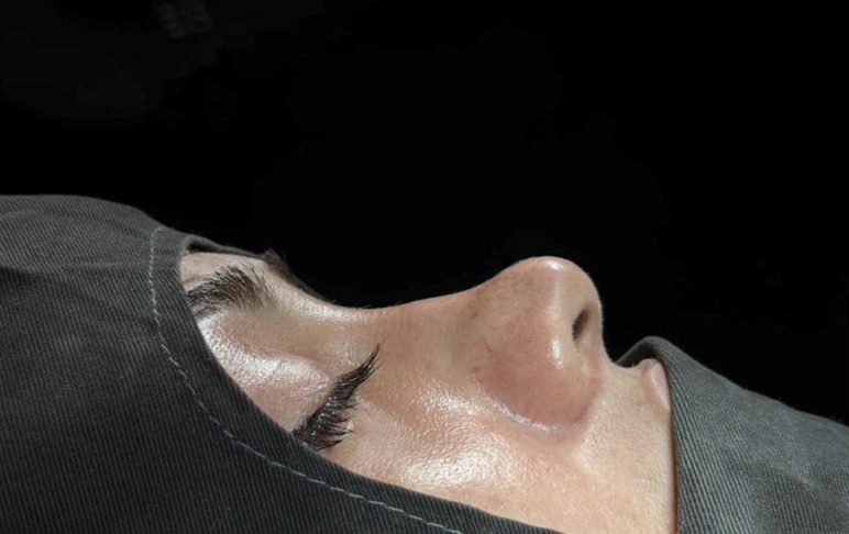 Before rhinoplasty - dorsal hump