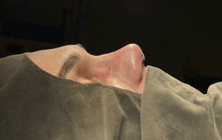 After - refined profile