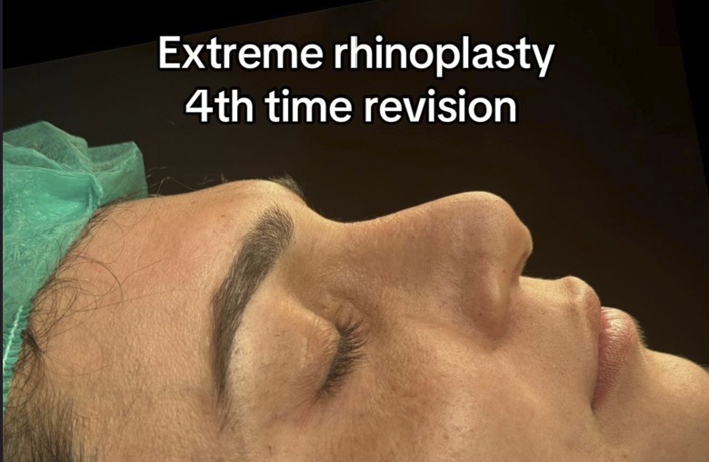 Before - nasal hump