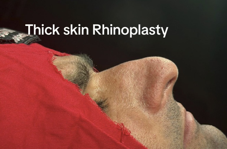 Before - thick skin wide nose