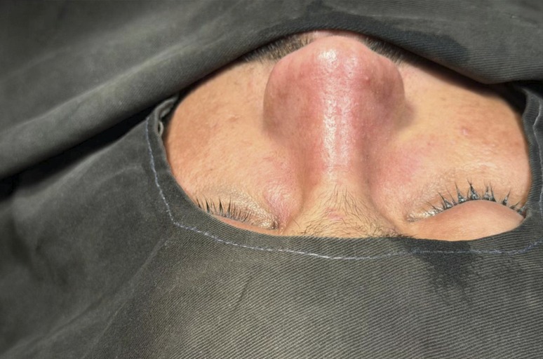 After rhinoplasty - defined tip
