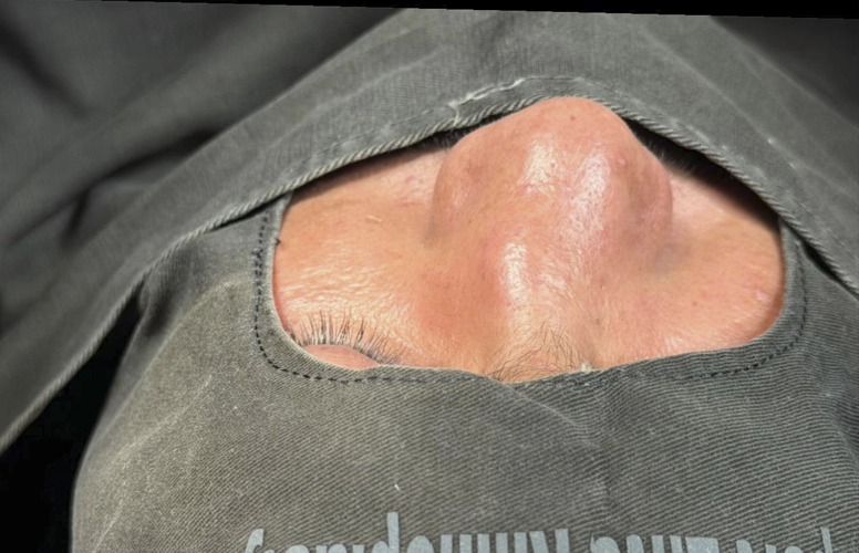 Before rhinoplasty - wide tip